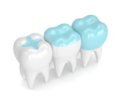 Dental Crowns and CEREC Same-Day Crowns in West Reno, South Reno, and Damonte Ranch, NV