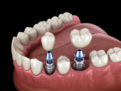 Dental Implants Demonstration from Elite Dental Aesthetics in Reno, NV