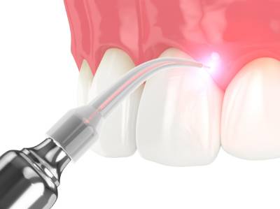 Laser Dentistry for faster healing at dentistry serving South Reno, West Reno, and Damonte Ranch, NV