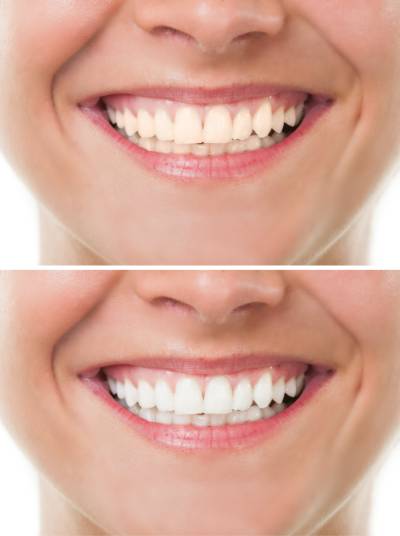 Before and After- teeth whitening for South Reno, West Reno, and Damonte Ranch, NV