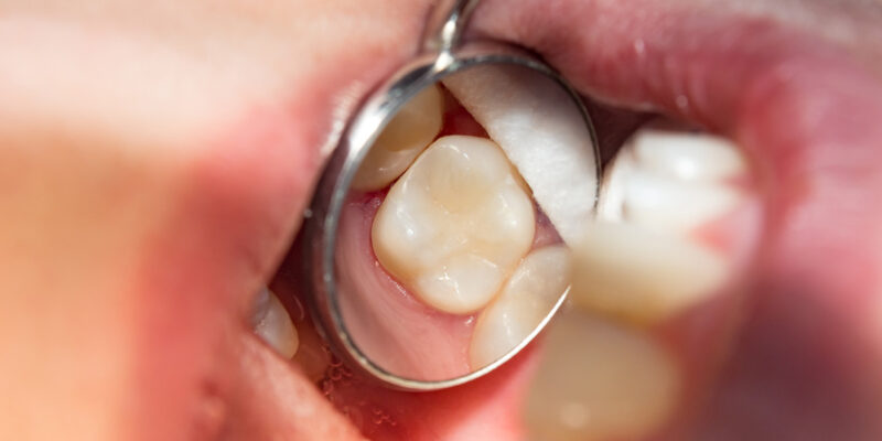 chewing side teeth