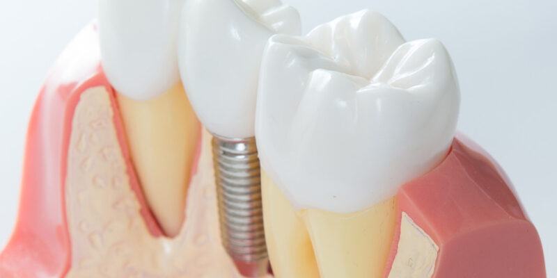 dental implant