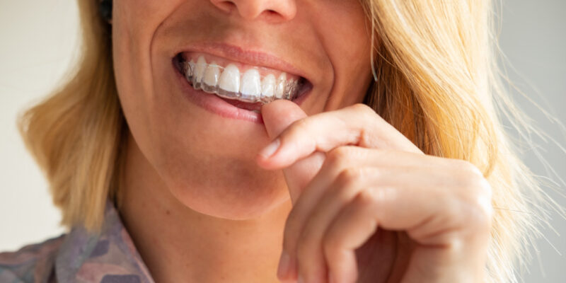 braces