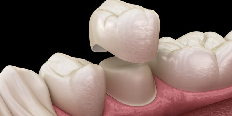 Dental crown premolar tooth assembly process. Medically accurate 3D illustration of human teeth treatment