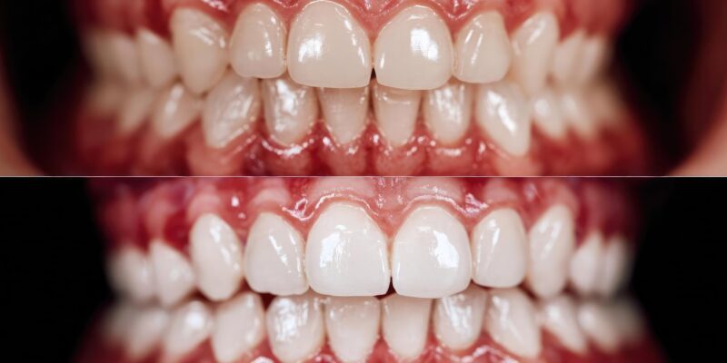 Before and after teeth whitening: top shows stained teeth and inflamed gums; bottom shows bright white teeth and pink gums. Concept Teeth whitening, Before/After, Gum health, Smile makeover