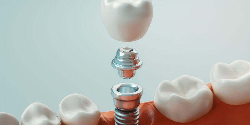 Dental care, dental implant, 3d rendering