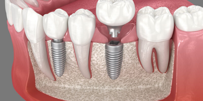 Premolar and Molar tooth implant installation. 3D illustration of dental treatment