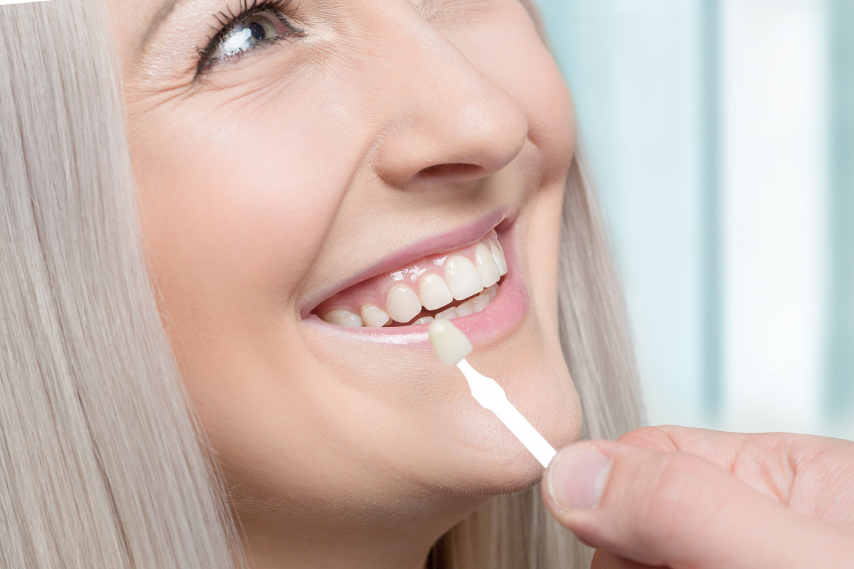 Using shade guide at mouth of smiling woman to check veneer of tooth crown
